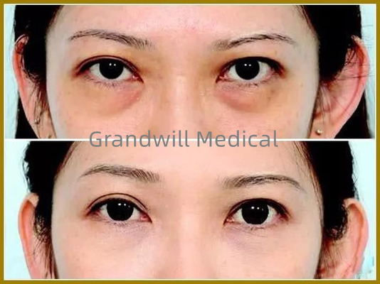 Hyaluronic όξινα του προσώπου δερμικά υλικά πληρώσεως για την πλήρωση του κύκλου ματιών γουρνών δακρυ'ων