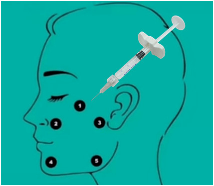 Υψηλός χαμηλός Hyaluronate νατρίου χ-εκτάριο Profhilo H+L 32mg εκχύσιμος - μοριακός