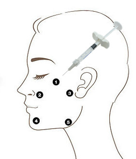 Ο cOem Profhilo H+L 32mg διασχίζει μη το συνδεμένο Hyaluronic όξινο υλικό πληρώσεως 5 έγχυση σημείων
