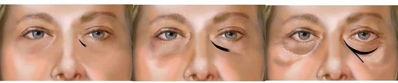 το εκχύσιμο Hyaluronic διάλυμα οξέος 1ml 2ml αφαιρεί τη σκοτεινή επεξεργασία κύκλων ματιών
