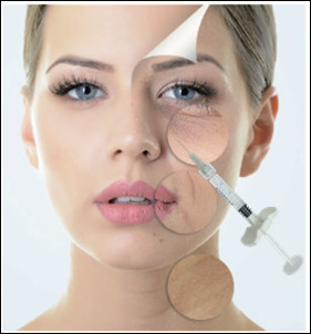 διαγώνια συνδεμένα Hyaluronic όξινα δερμικά υλικά πληρώσεως 1ml 1.1ml για το μάγουλο Midface μύτης