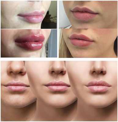 Ομαλές γραμμές/παχουλά χείλια με το Hyaluronic όξινο εκχύσιμο υλικό πληρώσεως 1ml 2ml 5ml