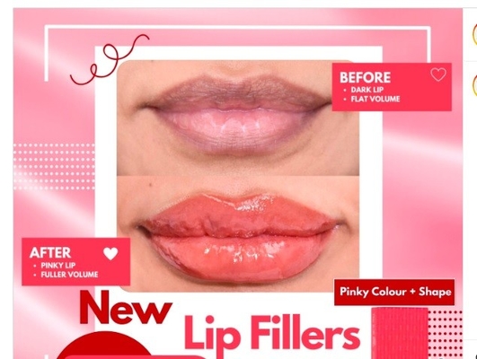 HYDROIAM Kiss με B12 Ha Filler Red Lips Filler Hyaluronic Acid Filler παρέχει φυσικό όγκο και χρώμα