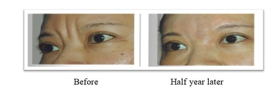 350 mg 150 mg PLLA Poly L Lactic Acid Dermal Filler Για τη θεραπεία των ρυτίδων στο πρόσωπο