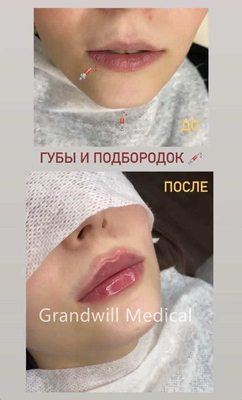 24 mg/ ml Ενέσιμο δερματικό γεμιστήρα υαλουρονικού οξέος για εξομάλυνση ρυτίδων