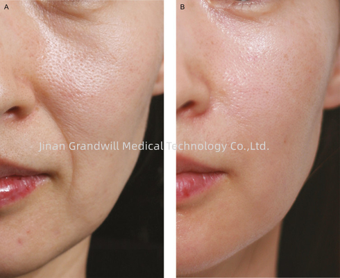 Miracle H L PCL Skin Booster Fine Line Polycaprolactone Υαλουρονικό οξύ για ένεση