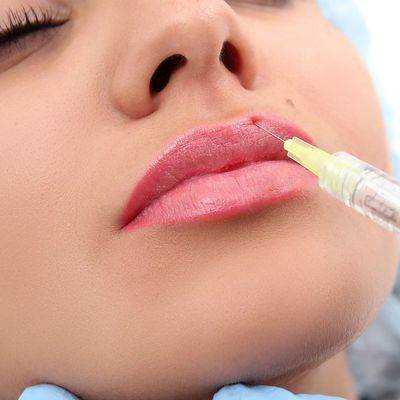 Πηκτωμάτων Hyaluronic όξινος φυσικός χειλικών υλικών πληρώσεως 24mg/Ml μορφής εκχύσιμος