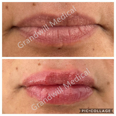 Δερμικό υλικό πληρώσεως 1ml 2ml πηκτωμάτων χειλικής αύξησης εκχύσιμο Hyaluronic όξινο