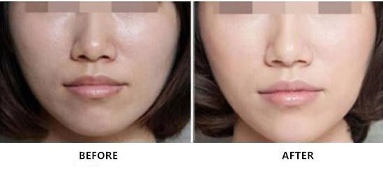 Μη συνδεμένη σταυρός έγχυση Hyaluronate Rejuvenating νατρίου για τη φροντίδα δέρματος