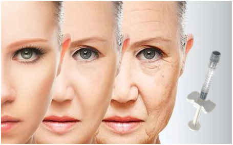Hyaluronic όξινο υλικό πληρώσεως 24mg/Ml προσώπου για τα πόδια των κοράκων καταθλίψεων μάγουλων