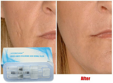 Hyaluronic όξινο εκχύσιμο υλικό πληρώσεως 10ml για την αύξηση πηγουνιών μάγουλων χειλικών εγχύσεων