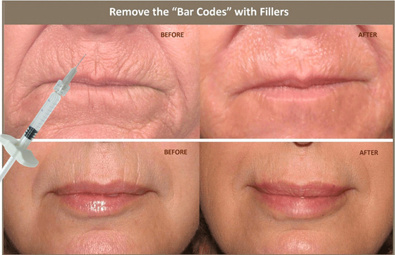 10ml εκχύσιμο Hyaluronic όξινο δερμικό υλικό πληρώσεως για τη διόρθωση της του προσώπου ασυμμετρίας