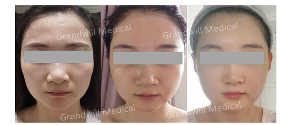 Hyaluronic όξινη PCL αφή θαύματος δερμάτων συμπληρωματική επάνω στο διεγερτικό κολλαγόνων δερμάτων