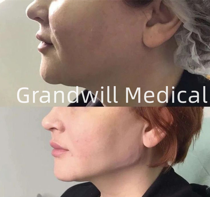 Hyaluronic όξινος ενισχυτής δερμάτων 2ml H+L 32mg/Ml για την του προσώπου αντι γήρανση ανύψωσης
