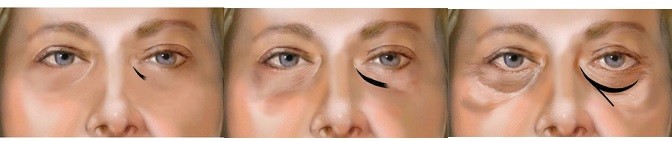 το εκχύσιμο Hyaluronic διάλυμα οξέος 1ml 2ml αφαιρεί τη σκοτεινή επεξεργασία κύκλων ματιών
